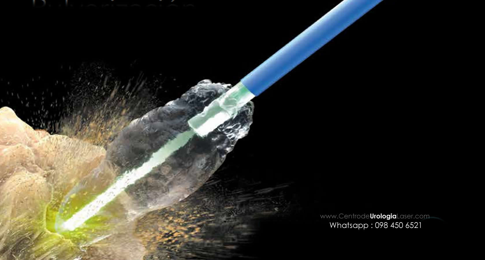 calculos renales quito